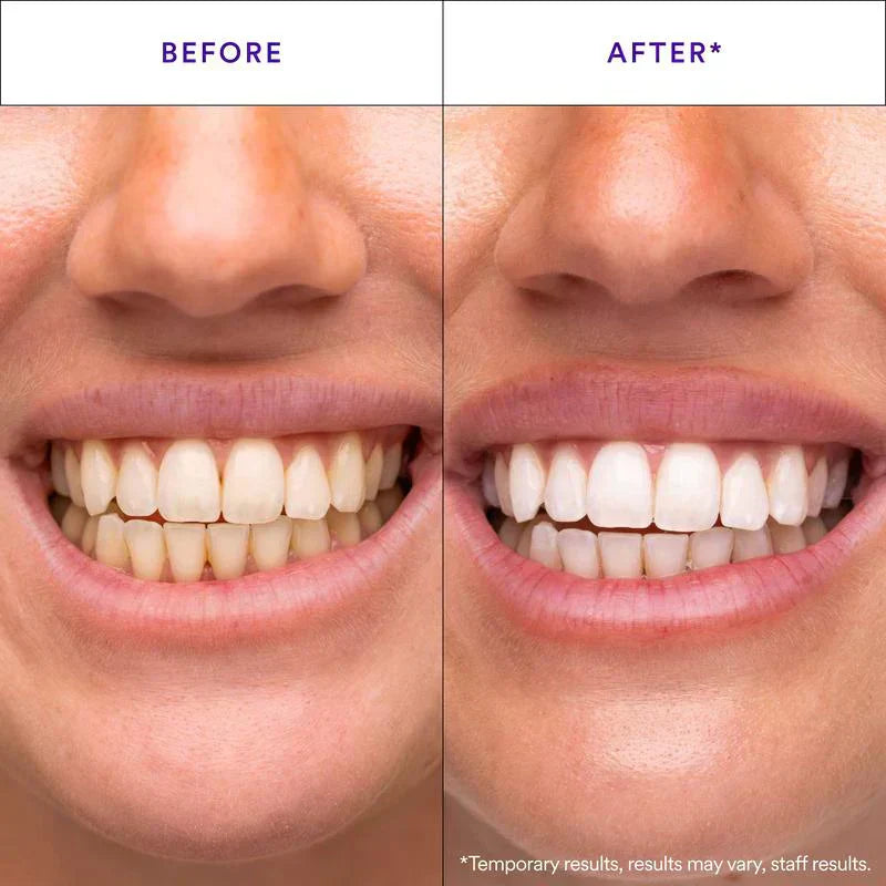 Teeth Whitening Strips