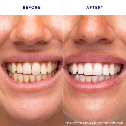 Teeth Whitening Strips